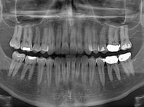 Regenerative Tooth Fillings