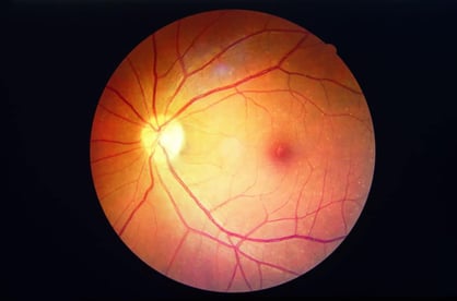 diabetic retinopathy stem cells
